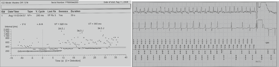 unspecified atrial flutter icd 10