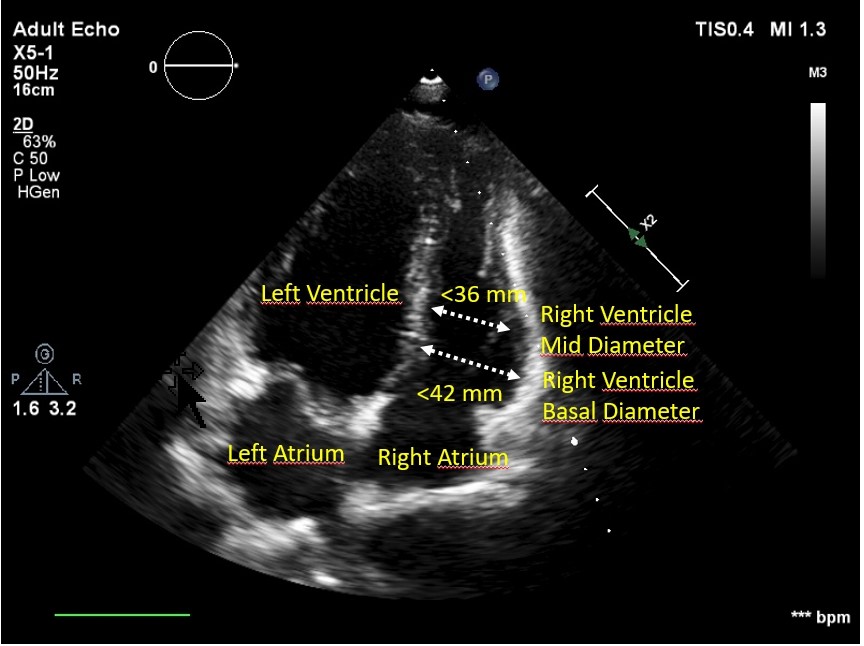 Sex- and Method-Specific Reference Values for Right Ventricular Strain by  2-Dimensional Speckle-Tracking Echocardiography