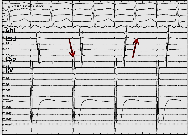 Description: Electrograms showing the sudden change in CS activation from... | Download  Scientific Diagram