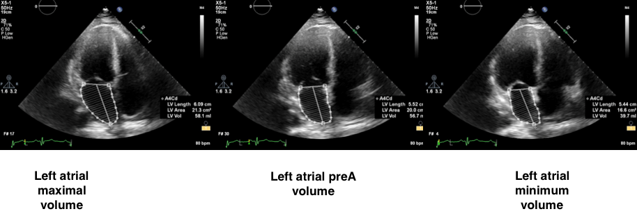 Normal Left Atrial Volume In Ml