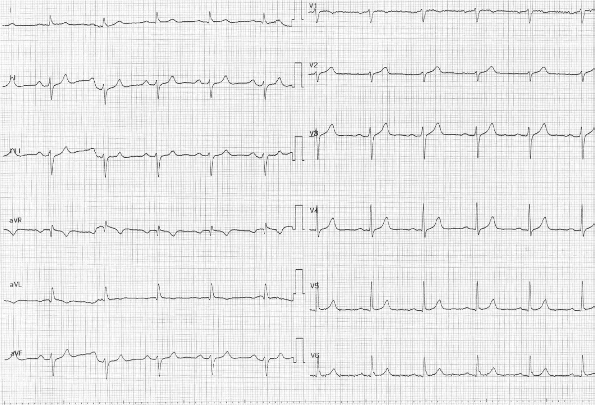 Complete degree. Left posterior fascicular Block.