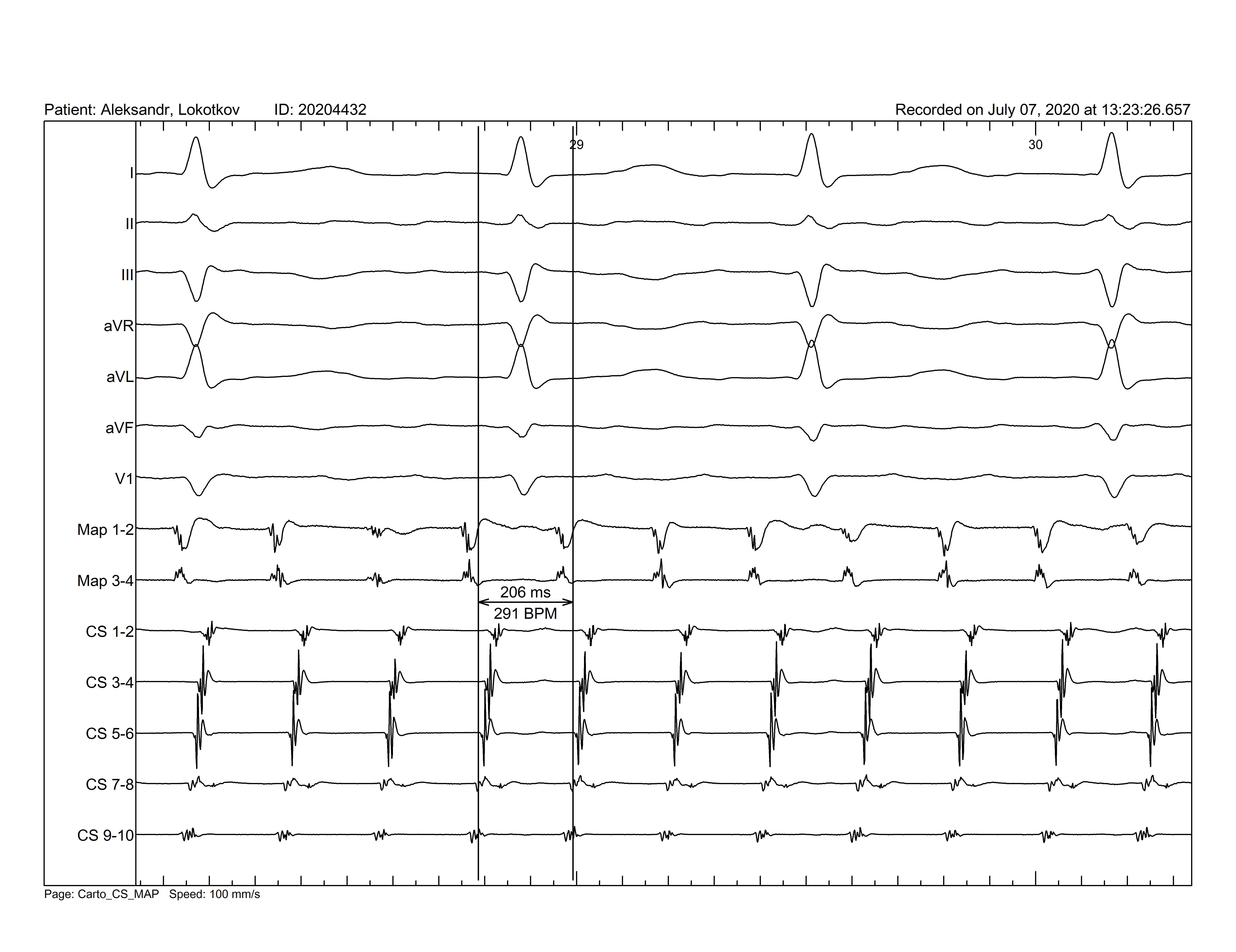Description: Description: Baseline EKG and endograms.jpg